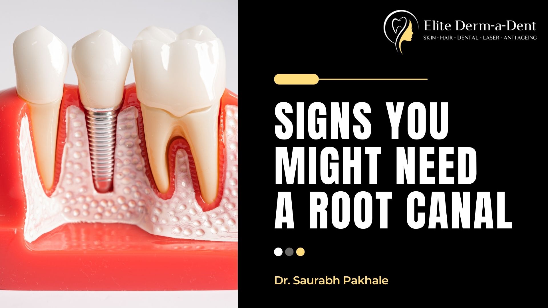 Signs You Might Need a Root Canal
