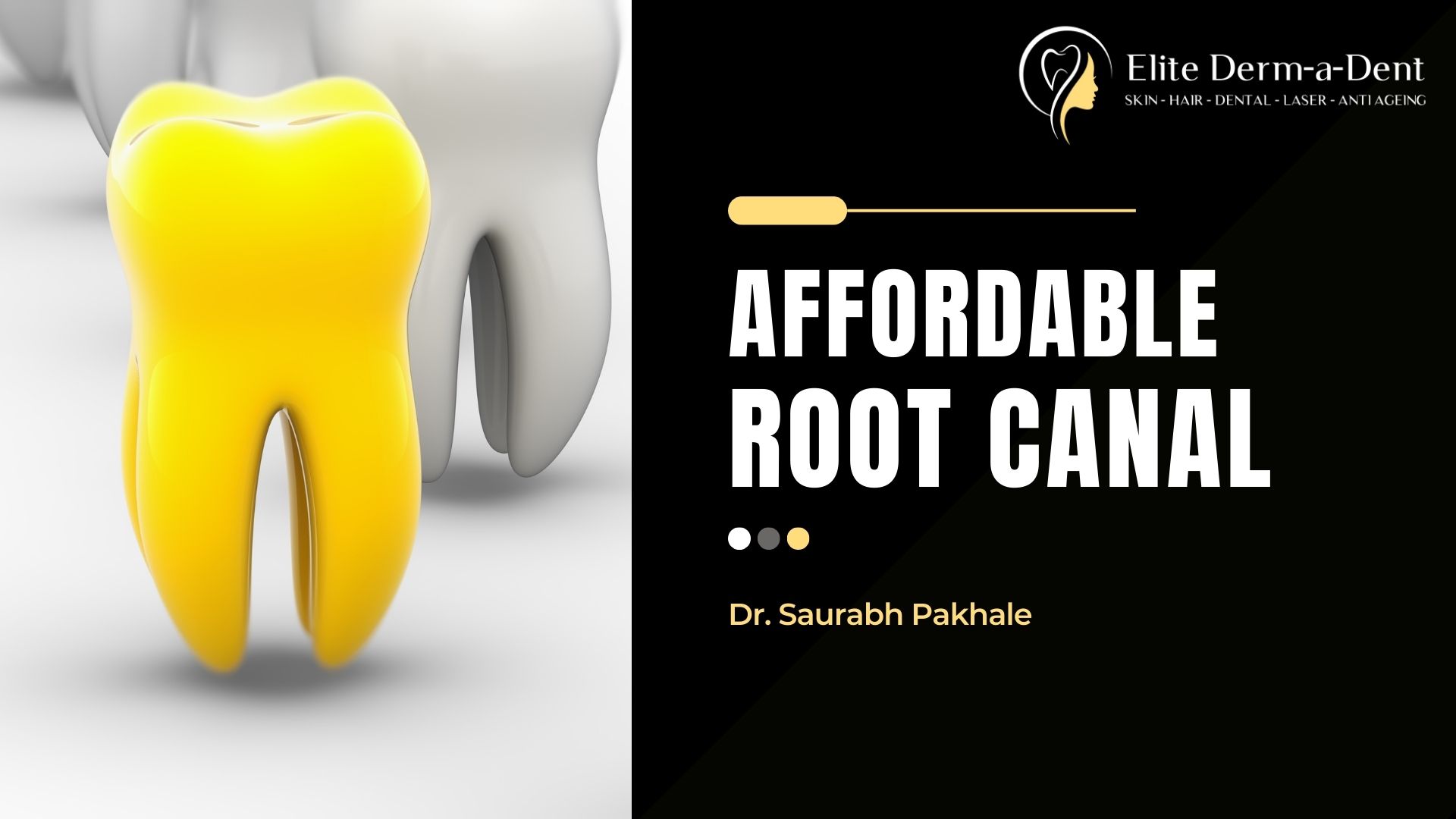 Affordable Root Canal in Thane