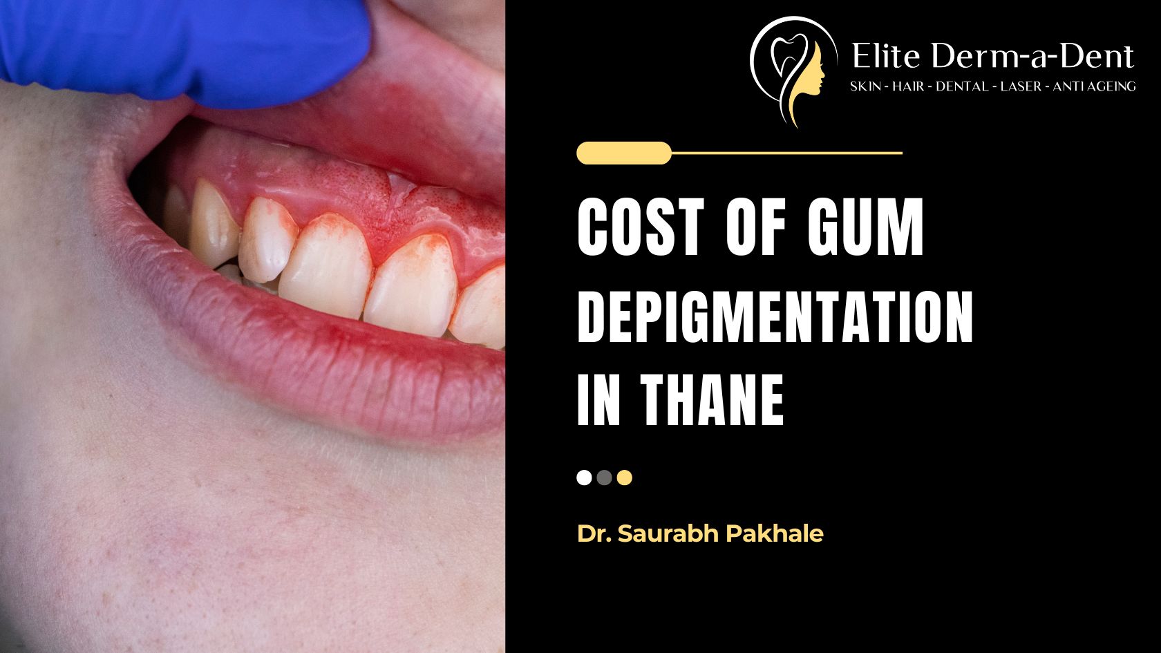 Cost of Gum Depigmentation Treatment in Thane