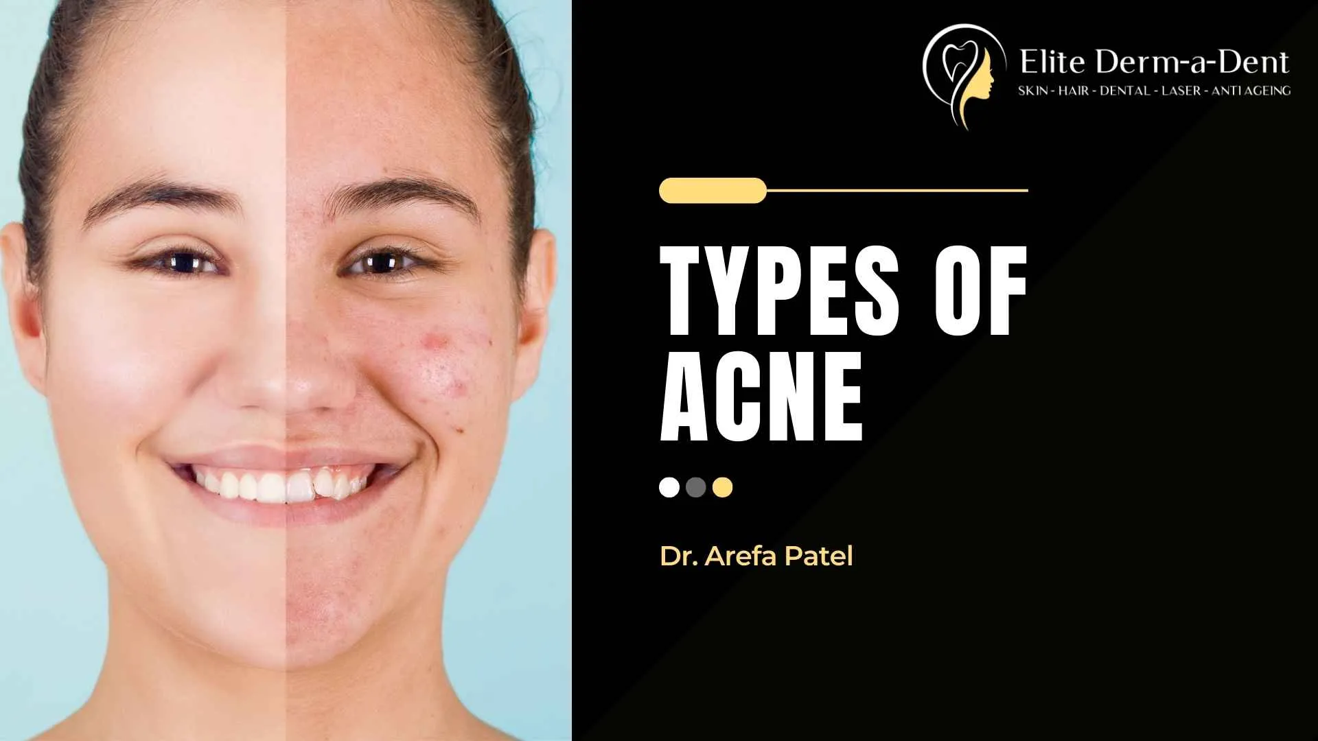 Types of Acne - Dr Arefa Patel