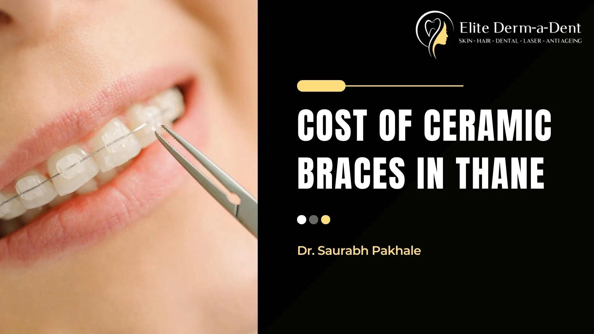 Understanding Cost of Ceramic Braces in Thane 2025: A Complete Guide