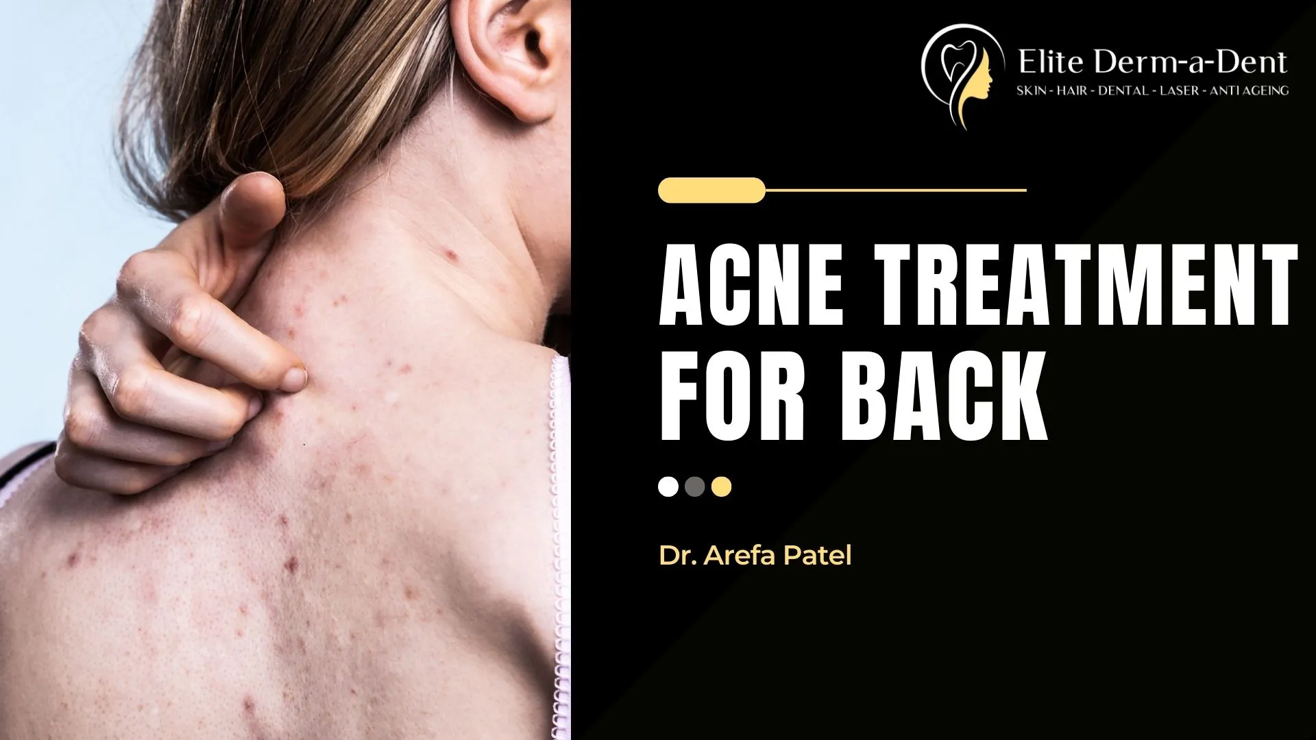Acne-Treatment-for-Back
