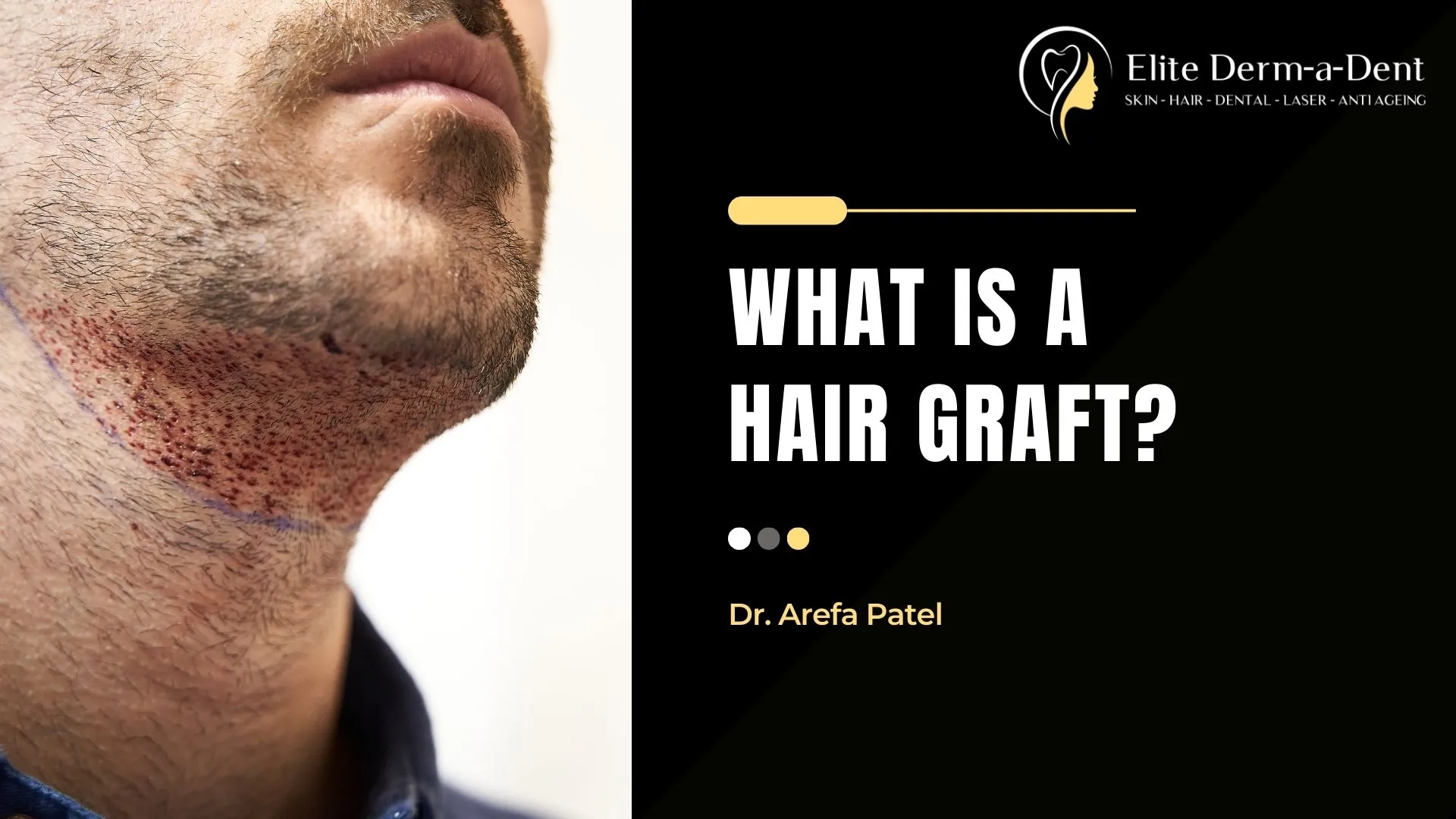 What is a Hair Graft? (2025) | Dr. Arefa Patel